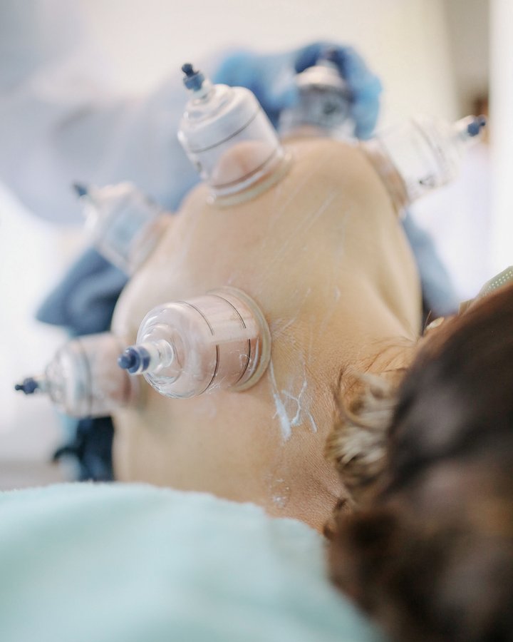Myofascial cupping therapy on the back
